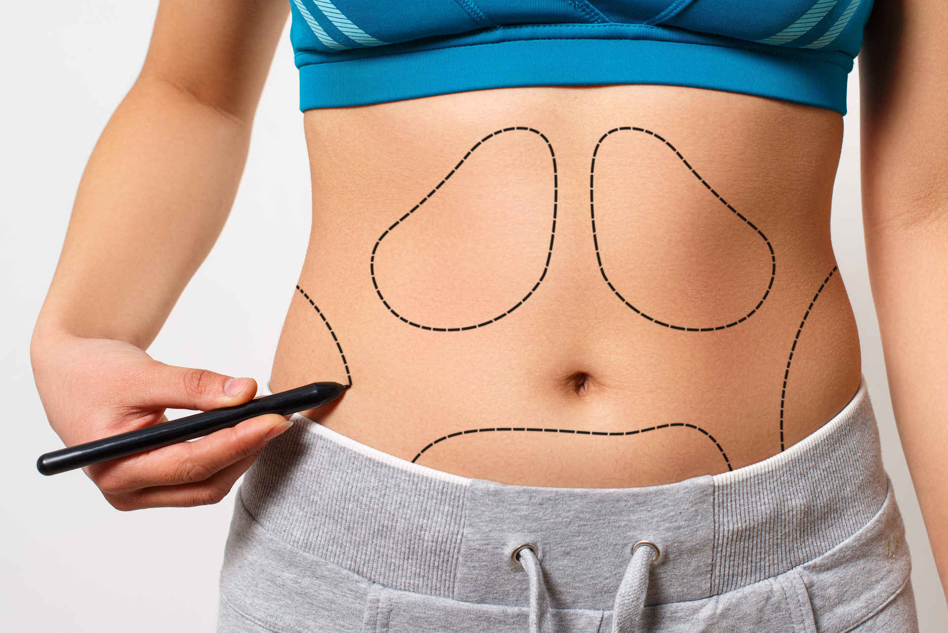 a woman shows a dotted line on her body liposuction zone. on white background